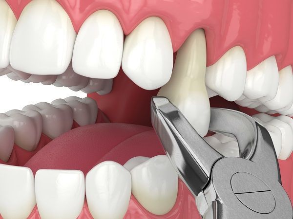 Tooth Extraction in Hyderabad
