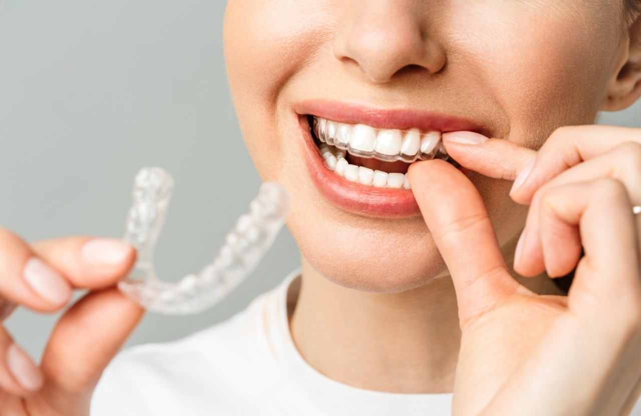 Invisalign Clear Aligners