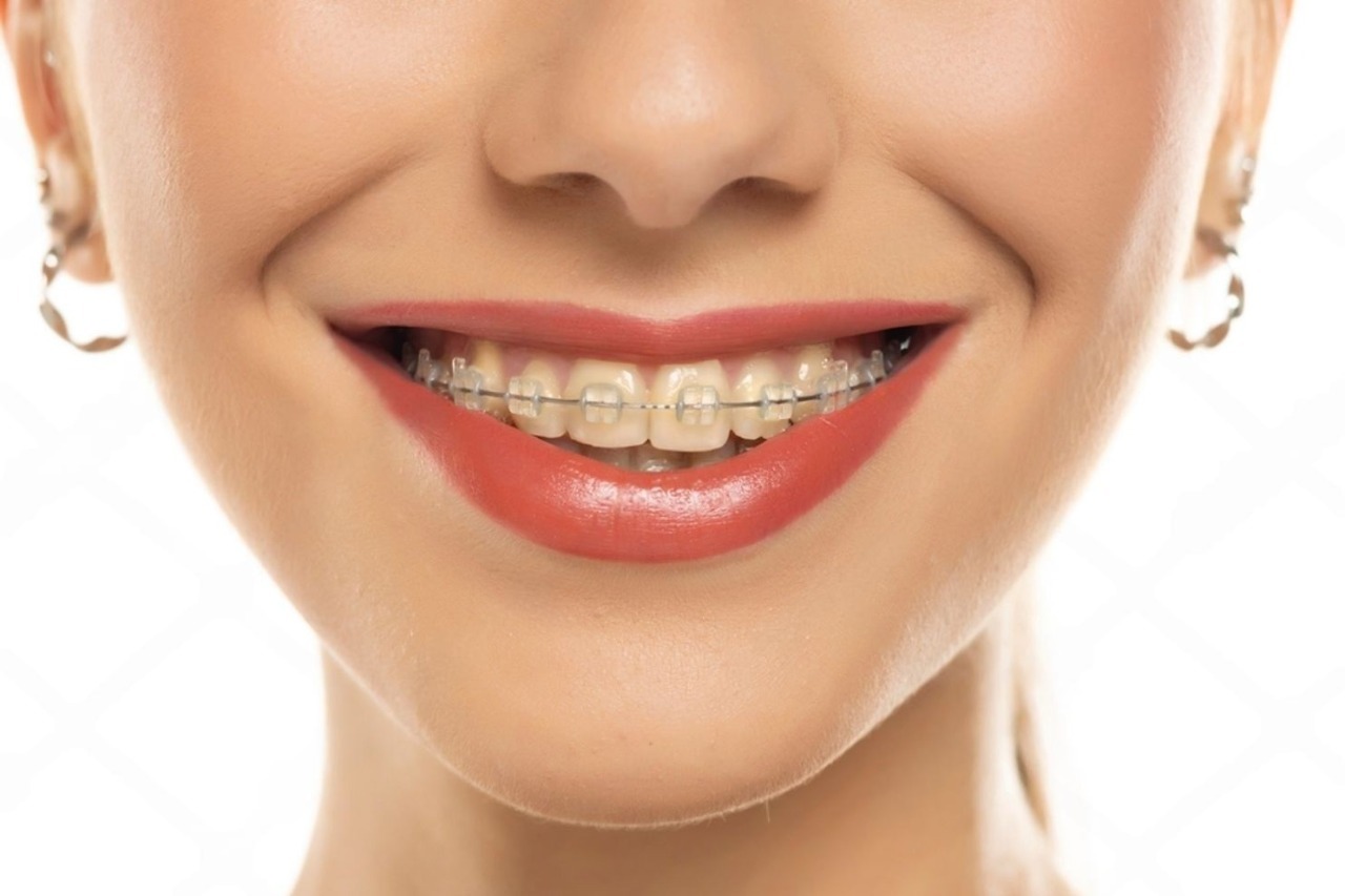 Orthodontic Braces Treatment
