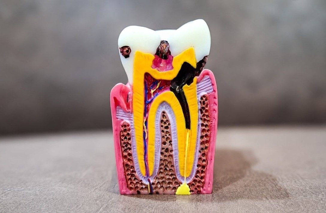 Root Canal Treatment in Hyderabad