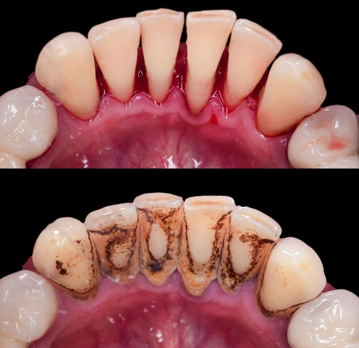 Teeth Cleaning and Scaling at The Tooth Story Dental Hyderabad