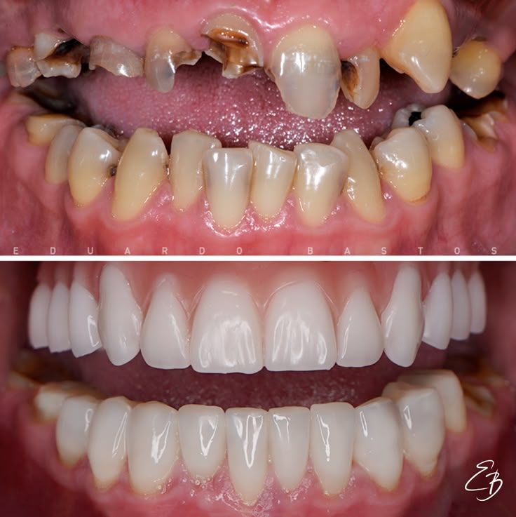 Oral Cyst and Tumor Removal procedure