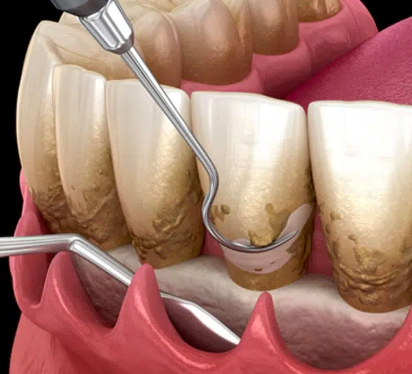 Flap Surgery Procedure