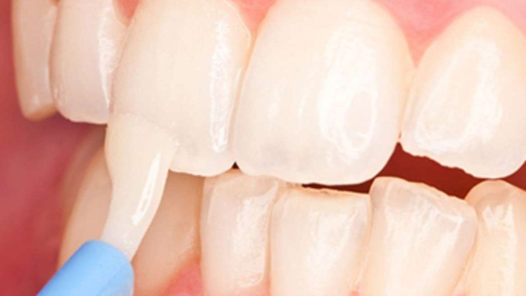 Professional Fluoride Treatment in Hyderabad