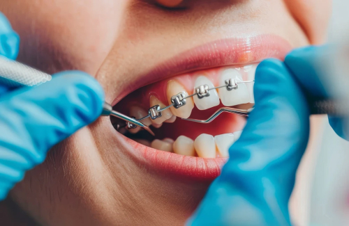 Braces (Metal / Ceramic)