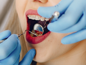 Fluoride Treatment Process