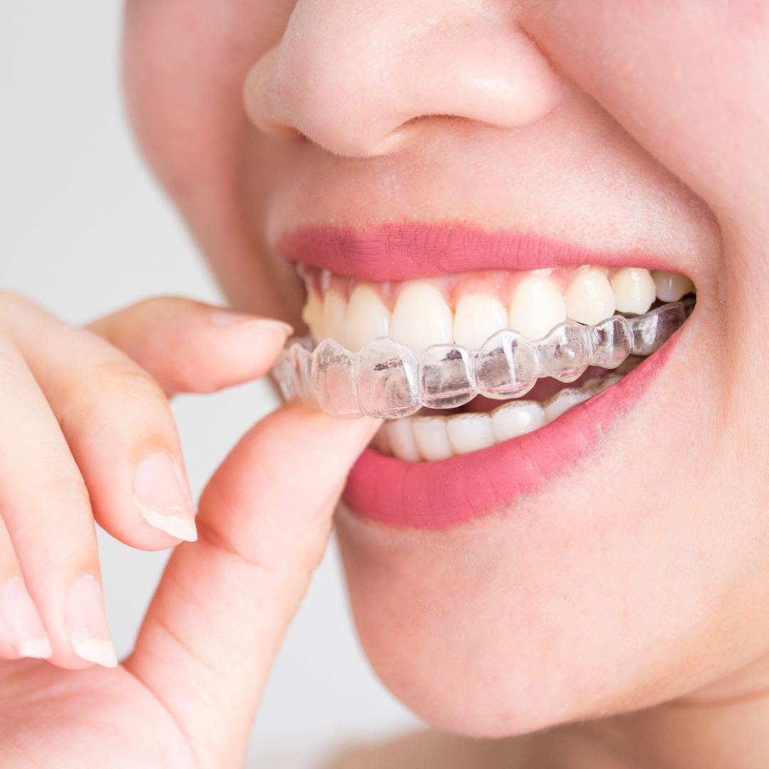 What is Invisalign