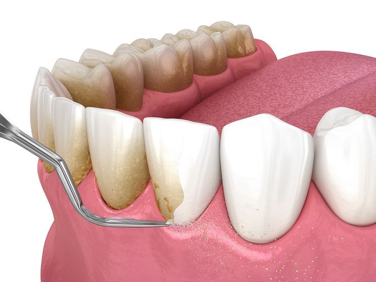 Advanced Gum Disease Treatment
