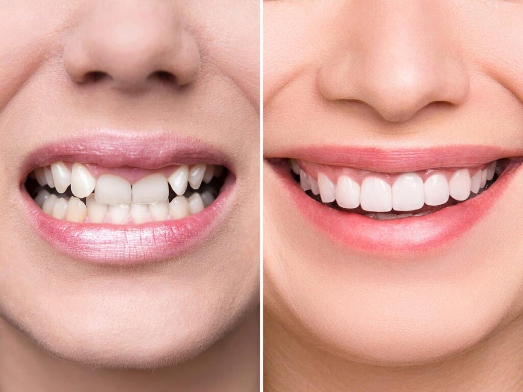 Dental Veneers Procedure
