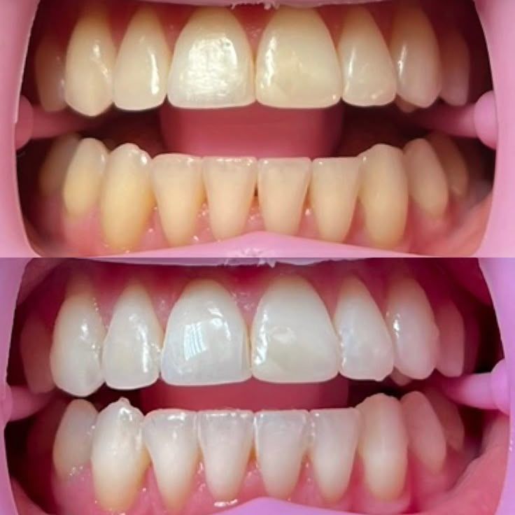 Teeth Whitening in Hyderabad