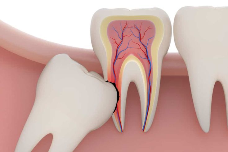 Tooth Extraction Procedure